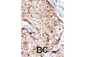 Formalin-fixed and paraffin-embedded human cancer tissue reacted with PAPSS2 polyclonal antibody  , which was peroxidase-conjugated to the secondary antibody, followed by AEC staining. (PAPSS2 anticorps  (C-Term))