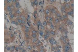 Detection of CALU in Human Breast cancer Tissue using Polyclonal Antibody to Calumenin (CALU)