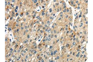 The image on the left is immunohistochemistry of paraffin-embedded Human liver cancer tissue using ABIN7190275(CLDN19 Antibody) at dilution 1/35, on the right is treated with synthetic peptide. (Claudin 19 anticorps)