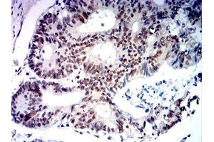 Immunohistochemical analysis of paraffin-embedded colon cancer tissues using MYCN mouse mAb with DAB staining.