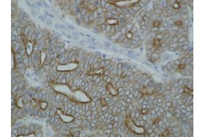 Immunohistochemistry staining of cytokeratin on paraffin-embedded sections of guinea pig breast carcinoma using anti-cytokeratin antibody (C-11).