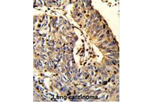 Formalin-fixed and paraffin-embedded human Lung carcinoma reacted with C21orf29 Antibody (Center), which was peroxidase-conjugated to the secondary antibody, followed by DAB staining.