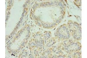Immunohistochemistry of paraffin-embedded human breast cancer using ABIN7168731 at dilution of 1:100 (SCAMP4 anticorps  (AA 170-228))