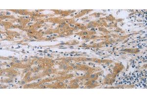 Immunohistochemistry of paraffin-embedded Human liver cancer using TNK2 Polyclonal Antibody at dilution of 1:70 (TNK2 anticorps)