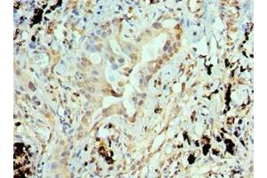 Immunohistochemistry of paraffin-embedded human lung cancer using ABIN7144325 at dilution of 1:100 (ANTXR1 anticorps  (AA 315-564))