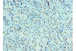 Immunohistochemistry of paraffin-embedded human breast cancer using ABIN7148701 at dilution of 1:100