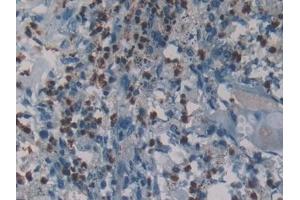 Detection of NE in Human Lung cancer Tissue using Polyclonal Antibody to Neutrophil Elastase (NE)