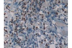 Detection of NE in Human Lung cancer Tissue using Polyclonal Antibody to Neutrophil Elastase (NE) (ELANE anticorps  (AA 30-247))