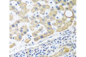 Immunohistochemistry of paraffin-embedded Human liver cancer using GLUD1 Polyclonal Antibody at dilution of 1:100 (40x lens). (GLUD1 anticorps)