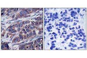 Immunohistochemical analysis of paraffin-embedded human breast carcinoma tissue using p62Dok(Phospho-Tyr362) Antibody(left) or the same antibody preincubated with blocking peptide(right).