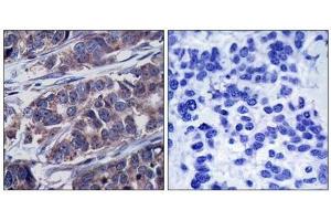 Immunohistochemical analysis of paraffin-embedded human breast carcinoma tissue using p62Dok(Phospho-Tyr362) Antibody(left) or the same antibody preincubated with blocking peptide(right). (DOK1 anticorps  (pTyr362))