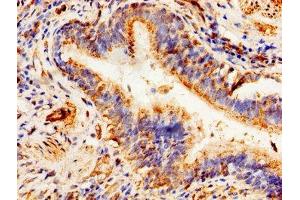 Immunohistochemistry of paraffin-embedded human lung cancer using ABIN7144912 at dilution of 1:100 (ABCD1 anticorps  (AA 632-745))