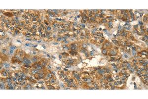 Immunohistochemistry of paraffin-embedded Human liver cancer using HSD17B8 Polyclonal Antibody at dilution of 1:55 (HSD17B8 anticorps)