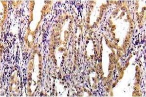 Immunohistochemistry (IHC) analyzes of STAT3 pAb in paraffin-embedded human lung carcinoma tissue. (STAT3 anticorps)