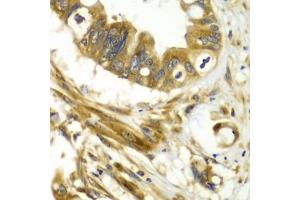 Immunohistochemistry of paraffin-embedded human liver cancer using GBP1 antibody (ABIN6293142) at dilution of 1:100 (40x lens).