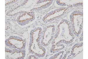 Immunohistochemical staining of paraffin-embedded Endometrial CA using YIPF4 antibody at a dilution of 1:500 (YIPF4 anticorps)