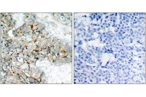 Immunohistochemistry analysis of paraffin-embedded human breast carcinoma, using Integrin beta3 (Phospho-Tyr773) Antibody.