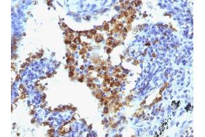 Formalin-fixed, paraffin-embedded human Lung Adenocarcinoma stained with Napsin-A Monoclonal Antibody (NAPSA/1238 + NAPSA/1239). (NAPSA anticorps  (AA 189-299))