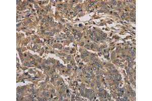 Immunohistochemistry of Human liver cancer using KIF22 Polyclonal Antibody at dilution of 1:30 (KIF22 anticorps)