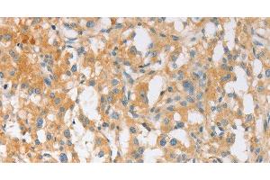 Immunohistochemistry of paraffin-embedded Human thyroid cancer using EPS15L1 Polyclonal Antibody at dilution of 1:30 (EPS15L1 anticorps)