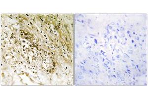 Immunohistochemistry analysis of paraffin-embedded human prostate carcinoma tissue, using PDZD2 antibody. (PDZD2 anticorps  (N-Term))