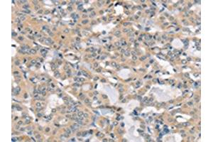 The image on the left is immunohistochemistry of paraffin-embedded Human thyroid cancer tissue using ABIN7192520(SLC6A8 Antibody) at dilution 1/30, on the right is treated with synthetic peptide. (SLC6A8 anticorps)