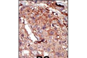 Formalin-fixed and paraffin-embedded human cancer tissue reacted with the primary antibody, which was peroxidase-conjugated to the secondary antibody, followed by AEC staining. (BRD2 anticorps  (AA 170-200))