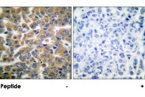 Immunohistochemical analysis of paraffin-embedded human breast carcinoma tissue using NR3C1 polyclonal antibody . (Glucocorticoid Receptor anticorps)