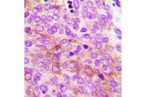 Immunohistochemical analysis of AMPK gamma 2 staining in human breast cancer formalin fixed paraffin embedded tissue section.