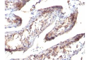 Formalin-fixed, paraffin-embedded human Testicular Carcinoma stained with TGF alpha Mouse Monoclonal Antibody (SPM357) (TGFA anticorps  (C-Term))