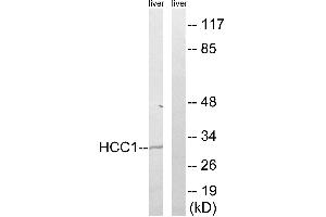 Immunohistochemistry analysis of paraffin-embedded human breast carcinoma tissue, using HCC1 antibody. (RBM39 anticorps  (Internal Region))