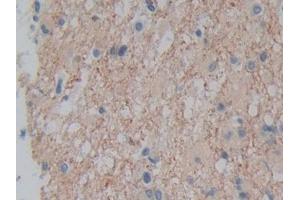 DAB staining on IHC-P; Samples: Human Glioma Tissue