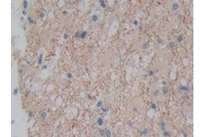 DAB staining on IHC-P; Samples: Human Glioma Tissue (Plexin A1 anticorps  (AA 43-300))