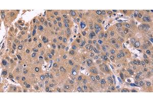 Immunohistochemistry of paraffin-embedded Human liver cancer tissue using CSNK1D Polyclonal Antibody at dilution 1:50 (Casein Kinase 1 delta anticorps)