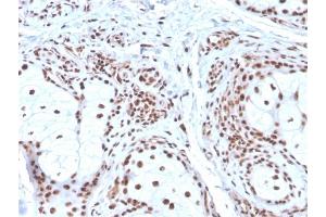 Formalin-fixed, paraffin-embedded human Basal Cell Carcinoma stained with Nucleophosmin Mouse Monoclonal Antibody (NPM1/3286). (NPM1 anticorps  (AA 185-287))