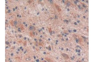 IHC-P analysis of Human Glioma Tissue, with DAB staining. (Reelin anticorps  (AA 26-190))