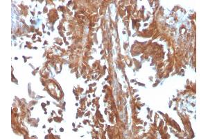 Formalin-fixed, paraffin-embedded human Urothelial Carcinoma stained with PAI-RBP1 Mouse Monoclonal Antibody (SERBP1/3497). (SERBP1 anticorps  (AA 3-139))