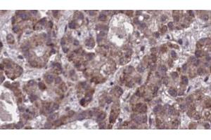 ABIN6273900 at 1/100 staining Human liver cancer tissue by IHC-P. (Purinergic Receptor P2Y, G-Protein Coupled, 13 (P2RY13) (C-Term) anticorps)