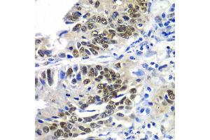 Immunohistochemistry of paraffin-embedded human colon carcinoma using DACH1 antibody at dilution of 1:100 (x40 lens). (DACH1 anticorps)