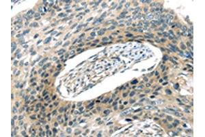 The image on the left is immunohistochemistry of paraffin-embedded Human esophagus cancer tissue using ABIN7193008(VAMP2 Antibody) at dilution 1/20, on the right is treated with synthetic peptide. (VAMP2 anticorps)