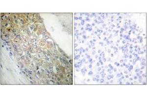 Immunohistochemistry analysis of paraffin-embedded human breast carcinoma tissue, using IR (Ab-1355) Antibody. (IR (AA 1326-1375) anticorps)