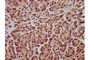 IHC image of ABIN7157012 diluted at 1:400 and staining in paraffin-embedded human pancreatic cancer performed on a Leica BondTM system.