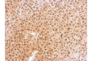 IHC-P Image RNF25 antibody [C2C3], C-term detects RNF25 protein at nucleus and cytosol on HeLa xenograft by immunohistochemical analysis.