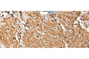 Immunohistochemistry of paraffin-embedded Human prost ate cancer tissue using MICU1 Polyclonal Antibody at dilution of 1:35(x200)