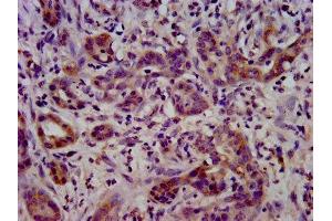 IHC image of ABIN7158426 diluted at 1:400 and staining in paraffin-embedded human pancreatic cancer performed on a Leica BondTM system. (LSR anticorps  (AA 112-233))