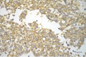Immunohistochemistry was performed on paraffin-embedded human breast carcinoma using protein regulator of cytokinesis 1 antibody (ABIN7800037), 1:200). (Recombinant PRC1 anticorps)