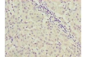 Immunohistochemistry of paraffin-embedded human liver cancer using ABIN7166922 at dilution of 1:100 (C9orf64 anticorps  (AA 182-341))