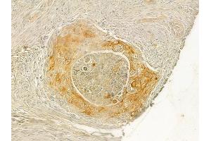 ABIN6265047 and ABIN6277646 at 1/100 staining human tongue carcinoma by IHC-P.