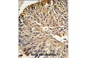 DHFR Antibody (C-term) (ABIN391566 and ABIN2841504) IHC analysis in formalin fixed and paraffin embedded human lung carcinoma followed by peroxidase conjugation of the secondary antibody and DAB staining. (Dihydrofolate Reductase anticorps  (C-Term))