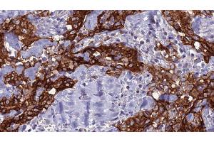 ABIN6277723 at 1/100 staining Human Head and neck cancer tissue by IHC-P. (SLC2A2 anticorps  (N-Term))